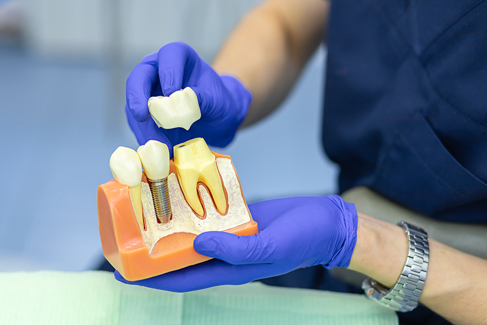 Dental Crowns and Bridges